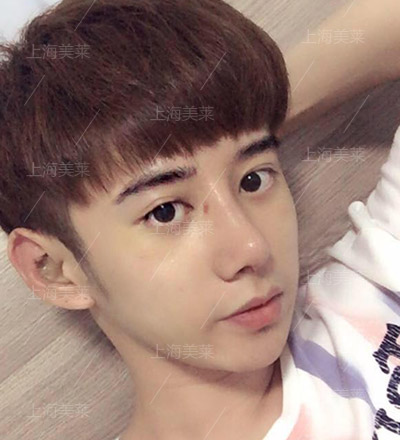 李?？?上海美萊自體軟骨隆鼻