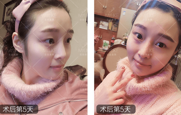 玻尿酸注射、+北京美萊無創(chuàng)案例