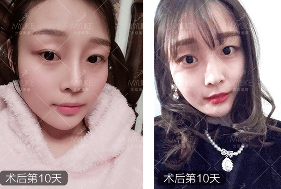 玻尿酸注射、+北京美萊無創(chuàng)案例