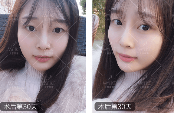 玻尿酸注射、+北京美萊無創(chuàng)案例
