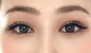 眼睛大小不一樣能開(kāi)眼角嗎
