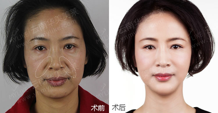 注射玻尿酸除皺手術后，需要注意哪些事項？