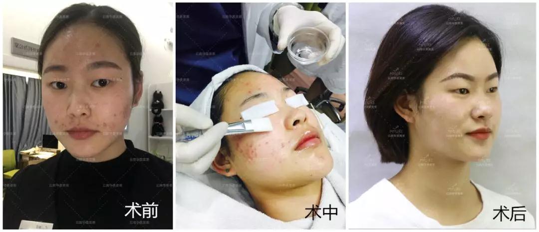 經(jīng)常長(zhǎng)痘，美萊果酸祛痘效果怎么樣