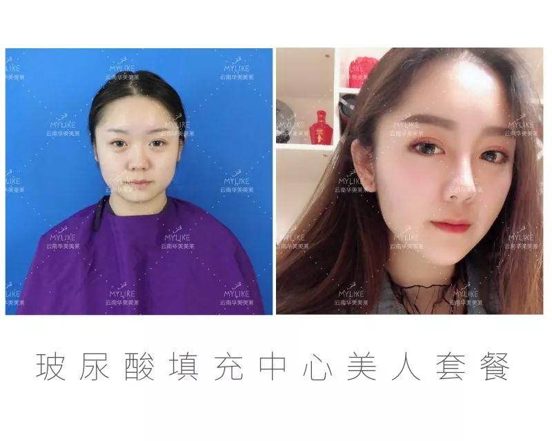 昆明打玻尿酸哪家好，打玻尿酸副作用有哪些？
