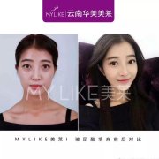 昆明打玻尿酸哪家好，打玻尿酸副作用有哪些？