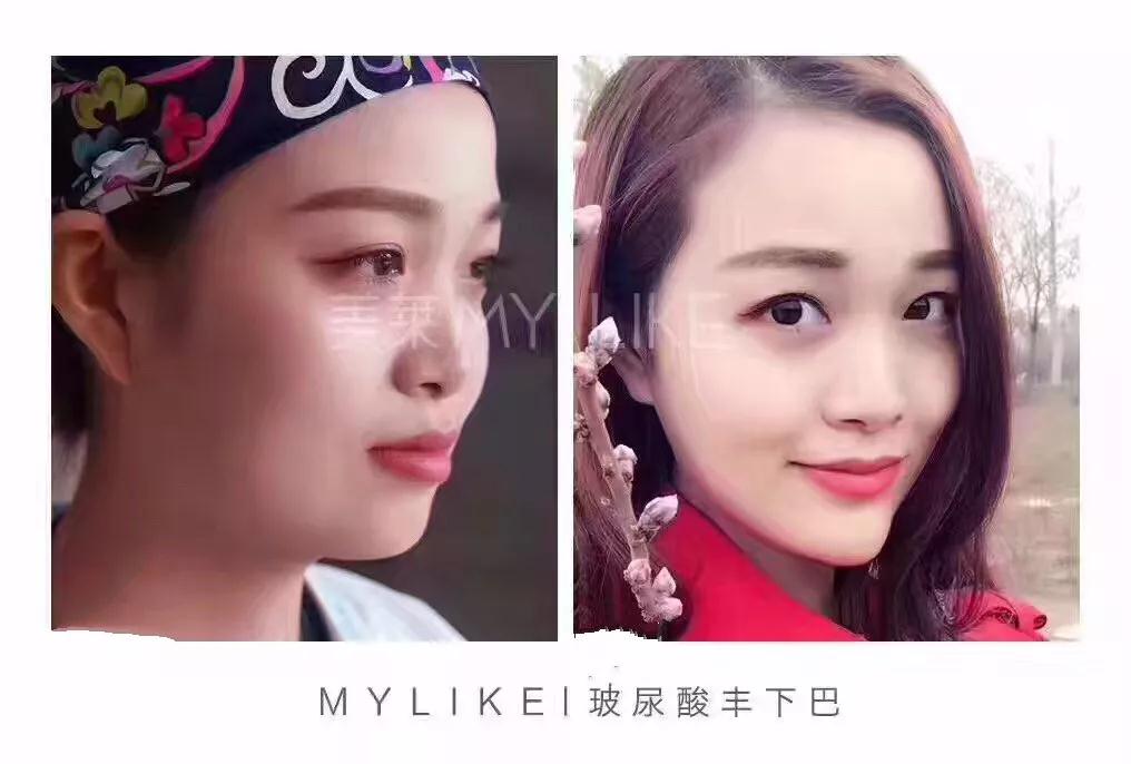 大中小分子玻尿酸有什么區(qū)別，法令紋又是用的什么