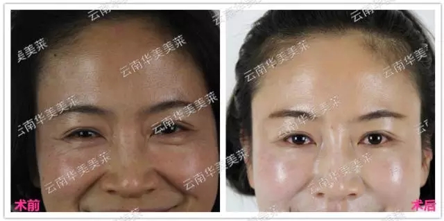 大中小分子玻尿酸有什么區(qū)別，法令紋又是用的什么