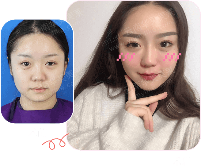 大中小分子玻尿酸有什么區(qū)別，法令紋又是用的什么