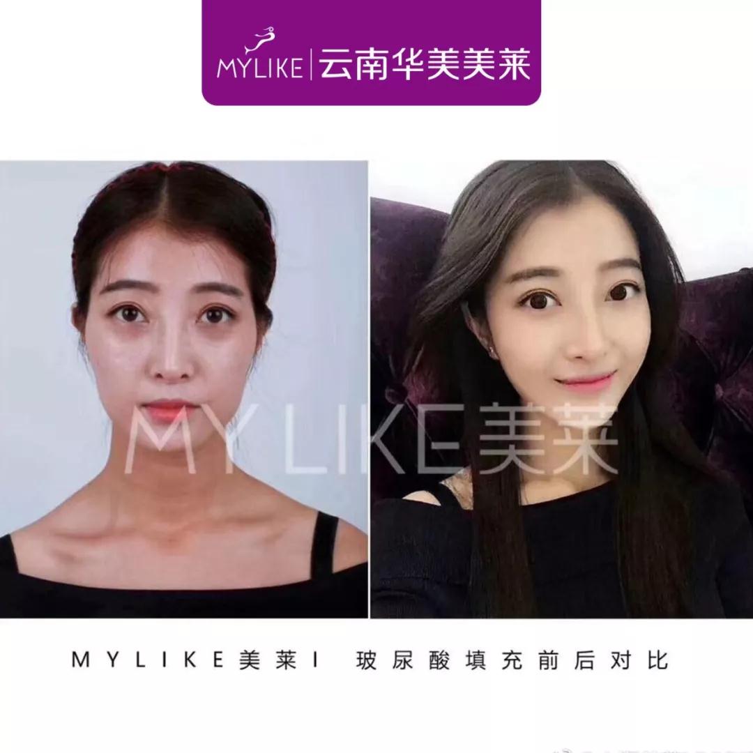選擇玻尿酸填充面部有副作用嗎，會不會凹凸不平?