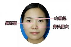 蘇州做韓式隆鼻手術要多少錢