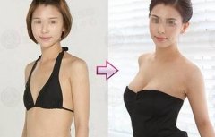 昆明假體隆胸的效果能保持多久？