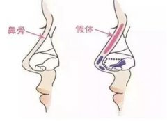 重慶假體隆鼻哪家醫(yī)院好?秀氣的鼻子更配你漂亮的臉蛋！