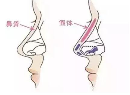 重慶假體隆鼻哪家醫(yī)院好?秀氣的鼻子更配你漂亮的臉蛋！