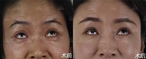 2018年過得很開心的你，皺紋有沒有增多？