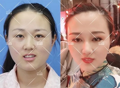 有些眼睛雙眼皮拯救不了，就來蘇州美萊做眼綜合手術(shù)！