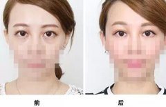 通過(guò)手術(shù)祛眼袋多久看都效果?會(huì)有疤痕嗎？