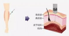 上海打瘦腿針的價格是多少？