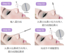 什么人適合做提升鼻？鼻頭大可以做嗎