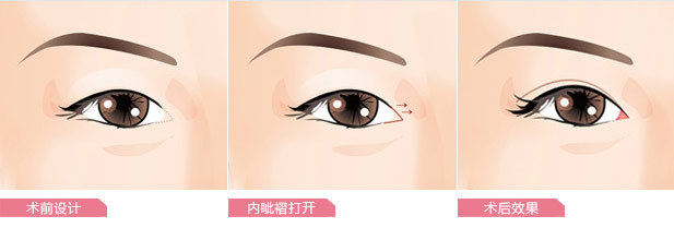 開眼角手術(shù)需要多久能恢復