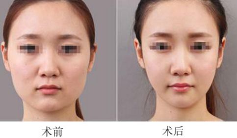 重慶面部吸脂能快速瘦臉嗎？