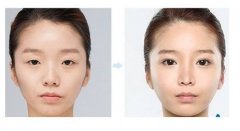 天津做上瞼下垂矯正的價(jià)格是多少？