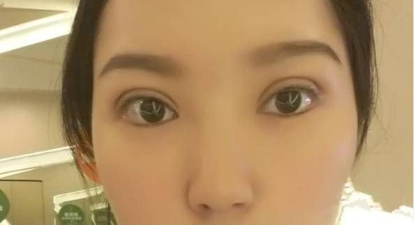 深圳做雙眼皮修是不是很貴？