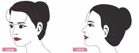 成都做自體脂肪面部填充可以維持十年嗎？