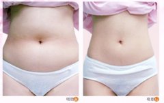 武漢適合做吸脂減肥手術(shù)的年齡段是多少？