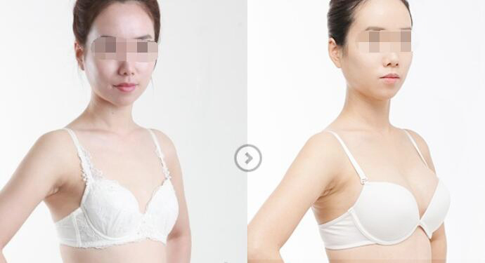 假體隆胸能夠維持多長(zhǎng)的時(shí)間？要如何護(hù)理？