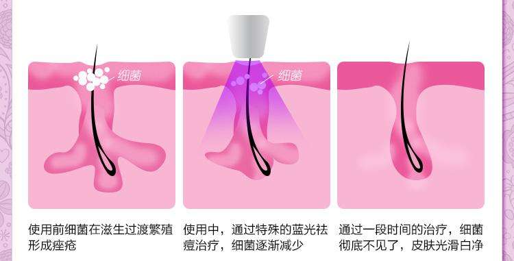北京彩光嫩膚祛痘印一般要多少錢(qián)