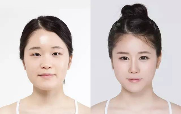 假體隆鼻術(shù)前有什么注意事項？