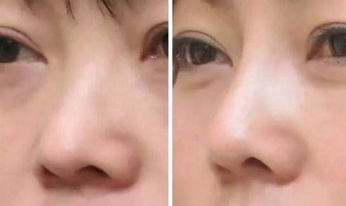 隆鼻后修復(fù)手術(shù)恢復(fù)時(shí)間會(huì)更長(zhǎng)嗎？
