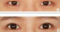 上眼瞼下垂怎么辦？