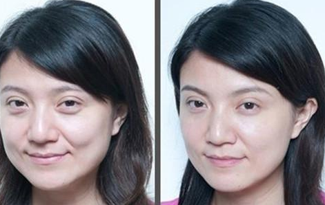 上眼瞼下垂怎么辦？