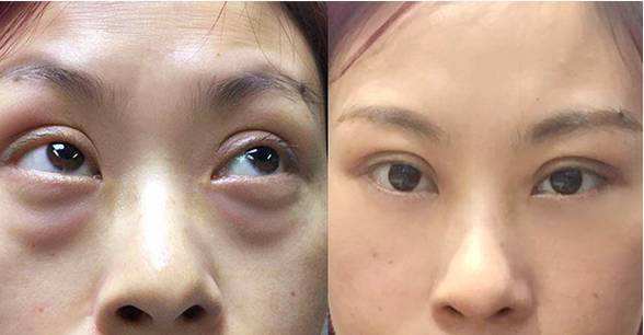 30歲就有眼袋怎么辦？