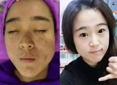 快速祛斑的方法有哪些？