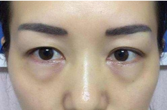 如何消除眼袋才有效？