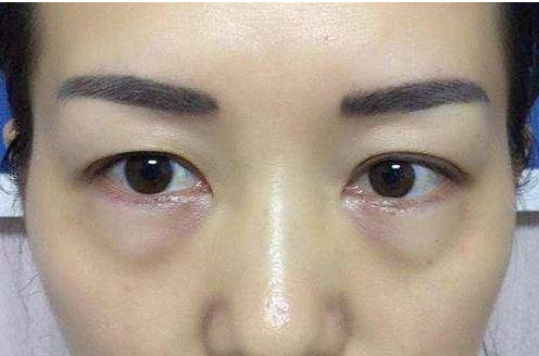 如何消除眼袋才有效？