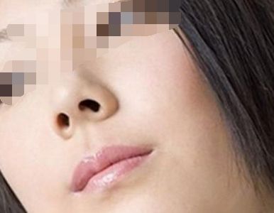 矯正鼻孔大的手術(shù)會(huì)留疤嗎？