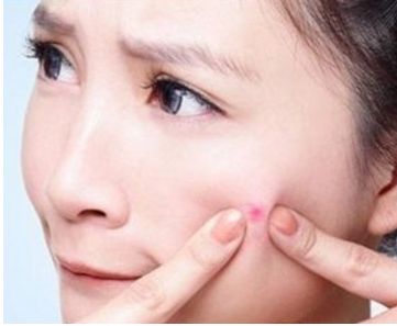 滿臉痘印怎么辦？