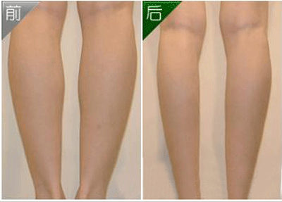 抽脂瘦腿多少錢？