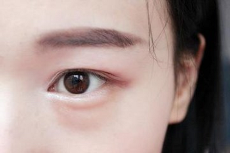 去眼袋的小竅門(mén)有哪些