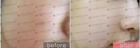 水光后為什么皮膚反而會變黑？