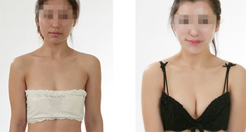 乳房再造手術(shù)有什么需要注意的？