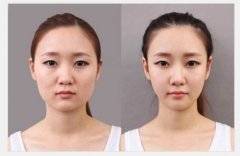 瘦臉針副作用有哪些？