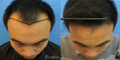 頭發(fā)種植后怎么護理？