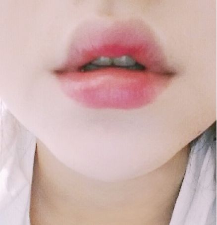 用玻尿酸豐唇后怎么護理？