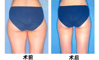 南京臀部吸脂減肥價格要多少錢？