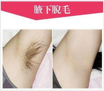 美萊冰點脫毛效果怎么樣？