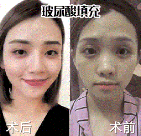 面對(duì)法令紋，玻尿酸or脂肪填充誰(shuí)才是救命大佬？